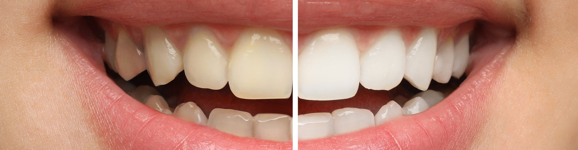 before and after of a teeth