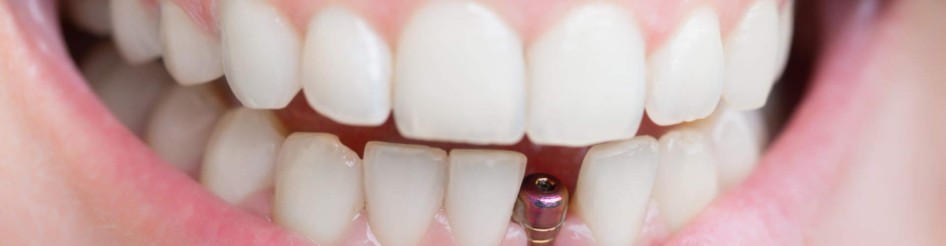 single tooth implant close up